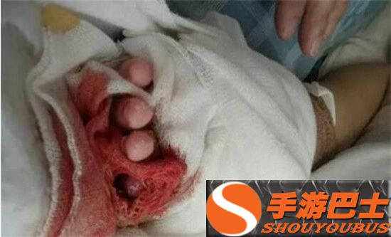 女婴被医生剪断指  不足1岁将忍受身体残疾的痛苦
